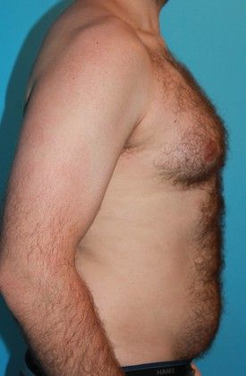 Gynecomastia Correction Before & After Image