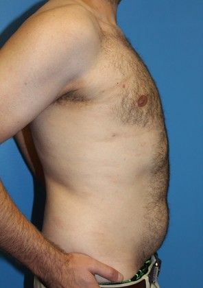 Gynecomastia Correction Before & After Image