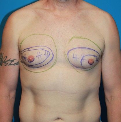 Gynecomastia Correction Before & After Image