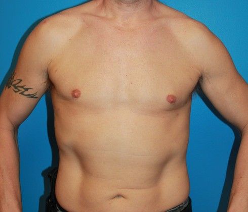 Gynecomastia Correction Before & After Image