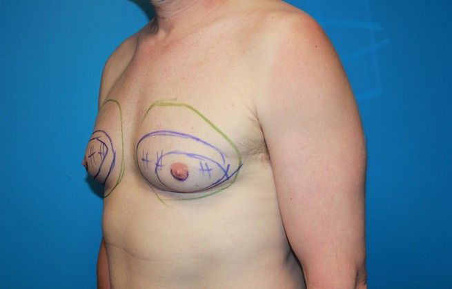 Gynecomastia Correction Before & After Image