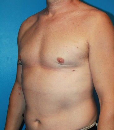 Gynecomastia Correction Before & After Image