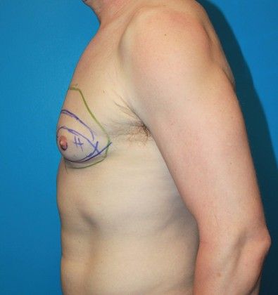 Gynecomastia Correction Before & After Image