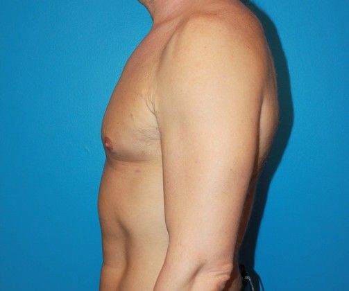 Gynecomastia Correction Before & After Image