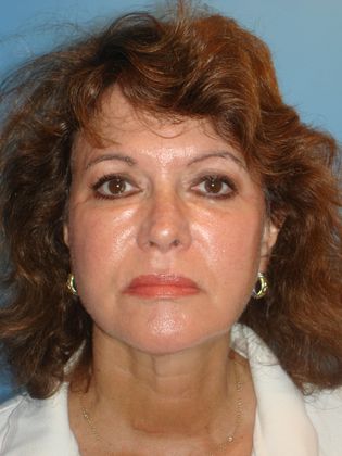 Facelift Before & After Image