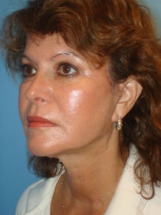 Facelift Before & After Image