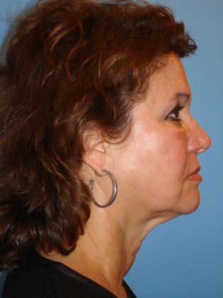 Facelift Before & After Image