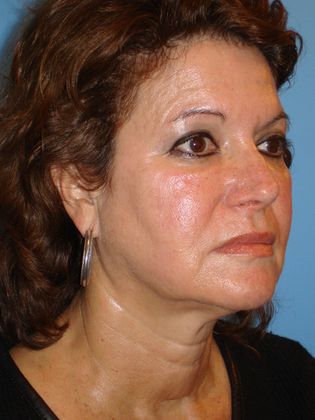 Facelift Before & After Image