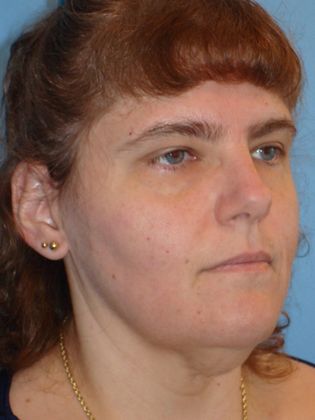 Facelift Before & After Image