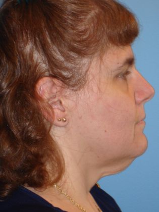 Facelift Before & After Image