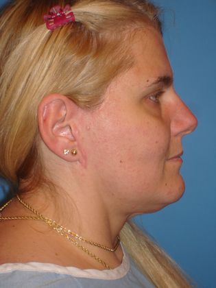 Facelift Before & After Image