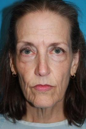 Facelift Before & After Image