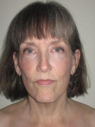 Facelift Before & After Image