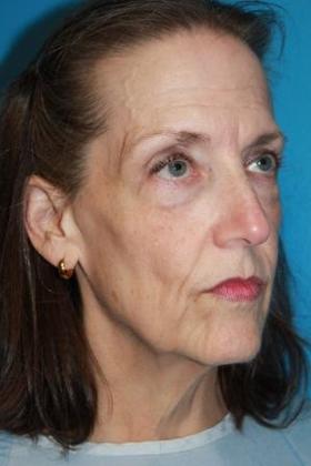 Facelift Before & After Image