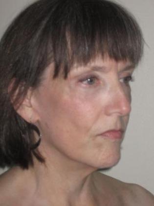 Facelift Before & After Image