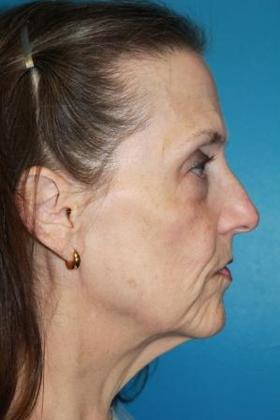 Facelift Before & After Image