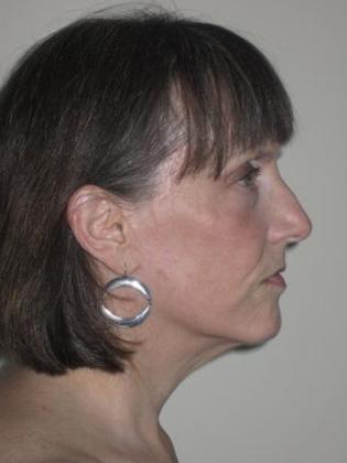 Facelift Before & After Image