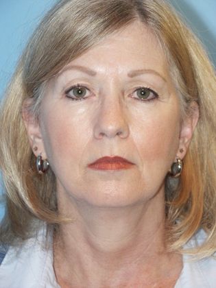 Facelift Before & After Image