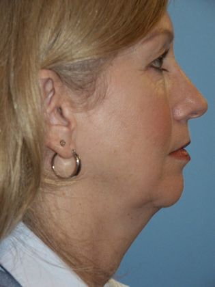 Facelift Before & After Image