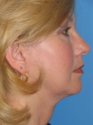 Facelift Before & After Image