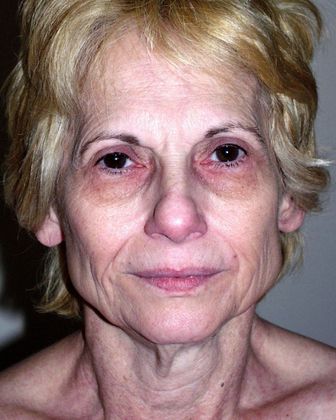 Facelift Before & After Image