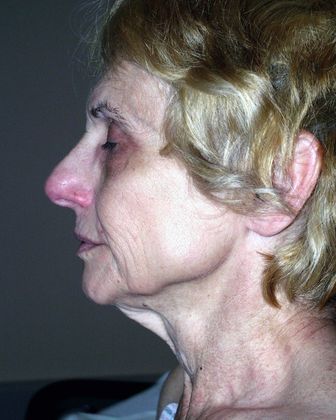 Facelift Before & After Image