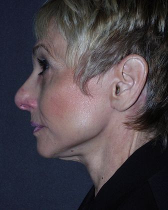 Facelift Before & After Image