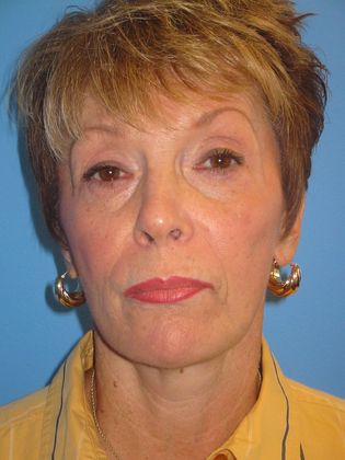 Facelift Before & After Image