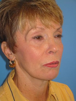 Facelift Before & After Image