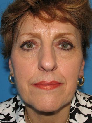 Facelift Before & After Image