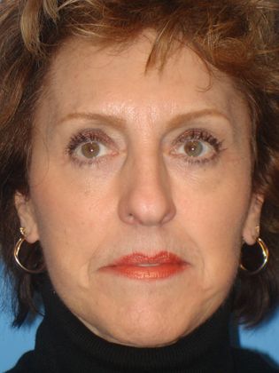 Facelift Before & After Image