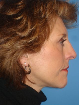 Facelift Before & After Image