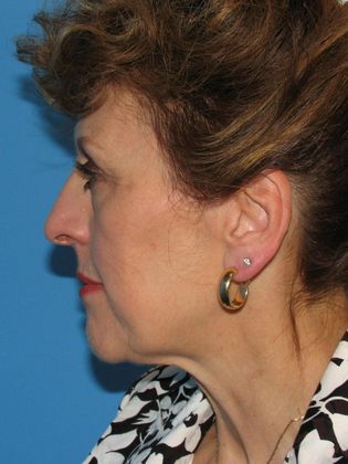 Facelift Before & After Image