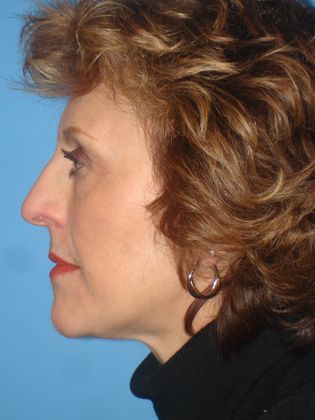 Facelift Before & After Image