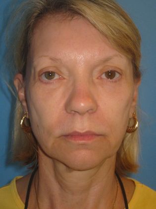 Facelift Before & After Image