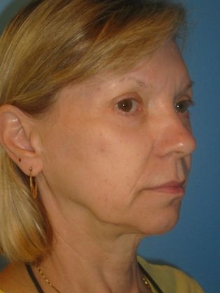 Facelift Before & After Image