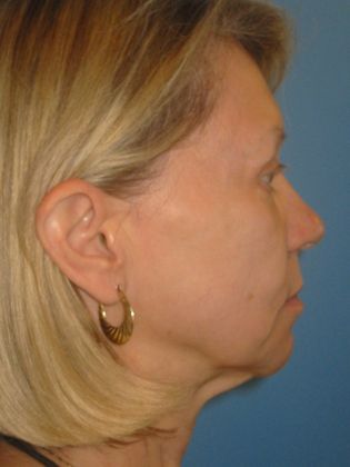 Facelift Before & After Image