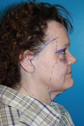 Facelift Before & After Image