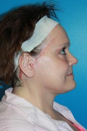 Facelift Before & After Image