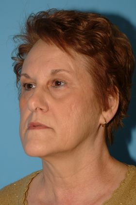 Facelift Before & After Image