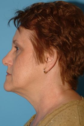 Facelift Before & After Image