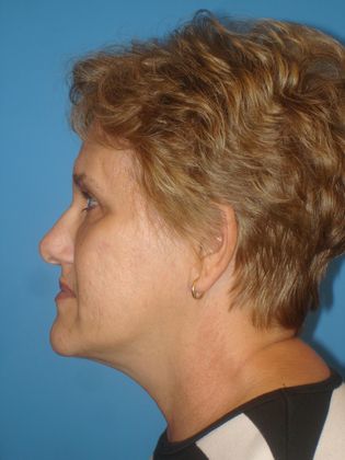 Facelift Before & After Image