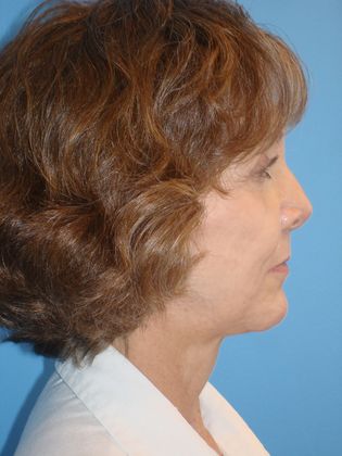 Facelift Before & After Image