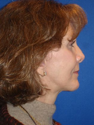 Facelift Before & After Image