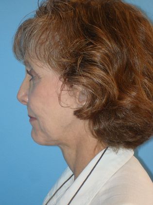 Facelift Before & After Image