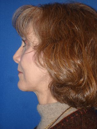 Facelift Before & After Image