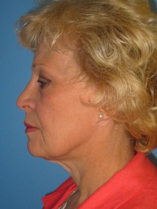 Facelift Before & After Image