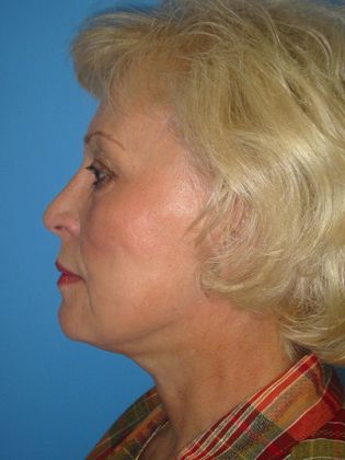 Facelift Before & After Image