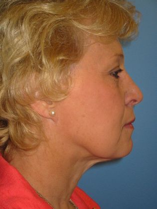 Facelift Before & After Image