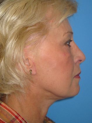 Facelift Before & After Image